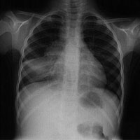 Chest X-Ray of Tuberculosis Patient file photo