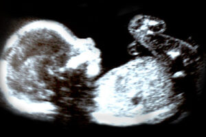 File Photo of Ultrasound of Unborn Child with Anti-Smoking Message, adapted from image at cdc.gov
